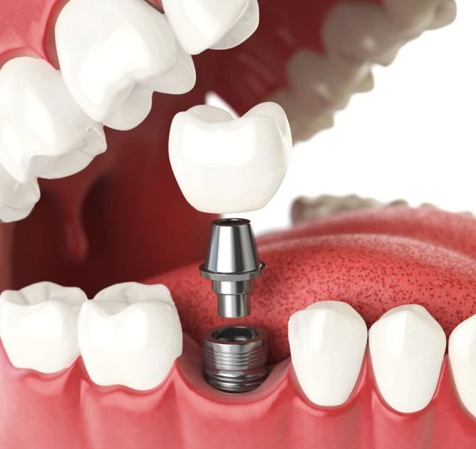 3D illustration showing dental implant with abutment and crown placement in jaw.
